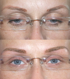 Before and after pictures of a woman's eyebrows.