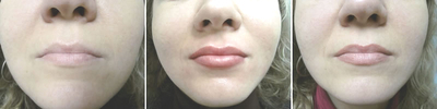 Four pictures of a woman's lips before and after lip injections.