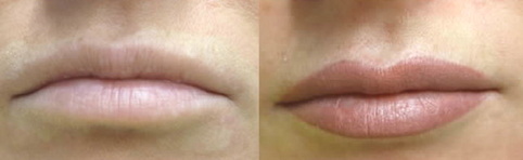 A woman's lips before and after lip injections.
