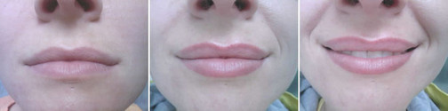 A woman's lips before and after lip injections.