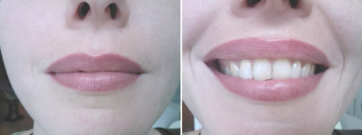 Before and after photos of a woman's teeth.