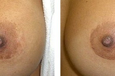 Before and after pictures of breast augmentation.