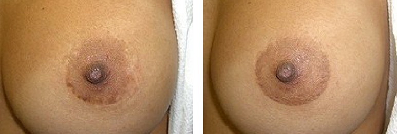 Before and after pictures of breast augmentation.