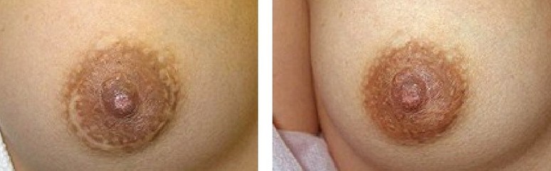 A woman's breast before and after a breast lift.