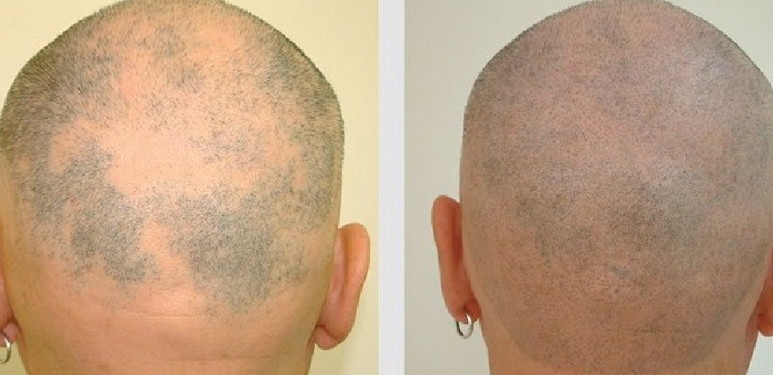 A man with hair loss before and after treatment.
