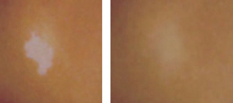 Before and after photo of a skin blemish.