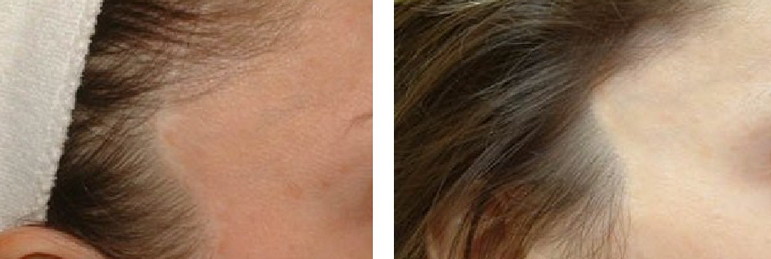 A woman's hair before and after a hair transplant.