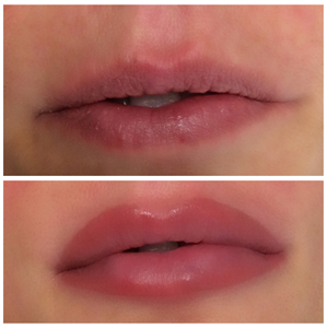 A woman's lips before and after lip injections.