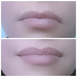 A woman's lips before and after lip filler.