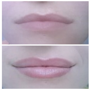 Before and after pictures of a woman's lips.