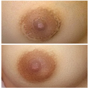 A woman's breast before and after a breast lift.