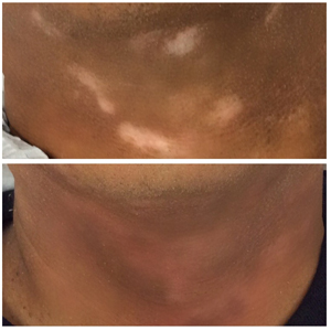 A man's neck before and after treatment.