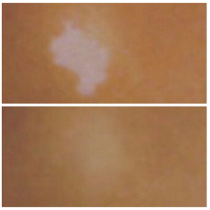 Two pictures of a person with a white spot on their skin.