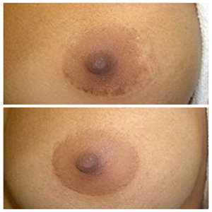 A woman's breast before and after a breast lift.