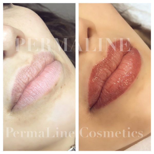 Two pictures of a woman's lips before and after lip filler.