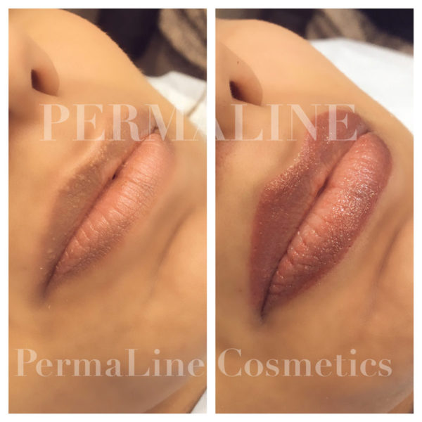 A photo of a woman's lips before and after a lip filler.