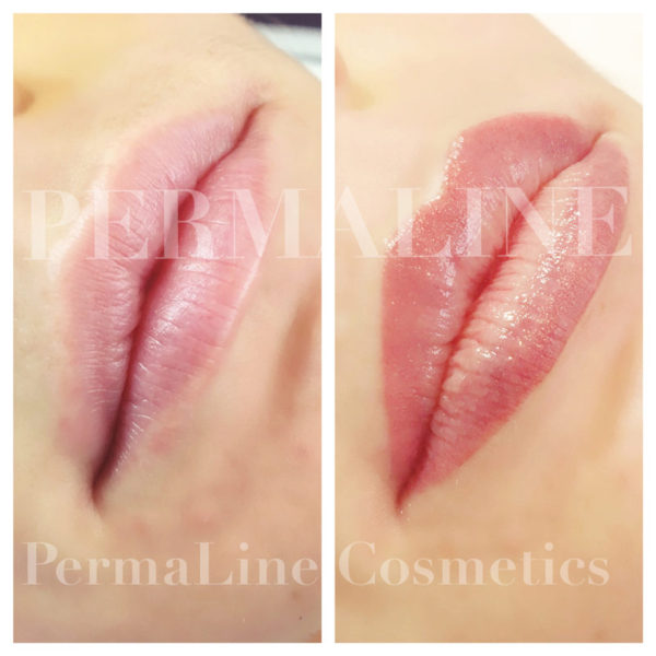 Two pictures of a woman's lips before and after lip filler.
