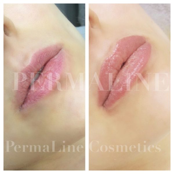 Two pictures of a woman's lips before and after lip filler.