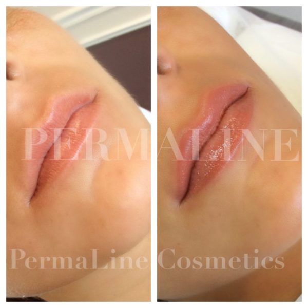 Two pictures of a woman's lips before and after a lip filler treatment.