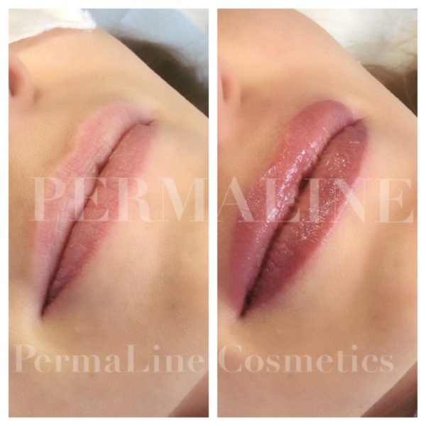 A picture of a woman's lips before and after lip filler.