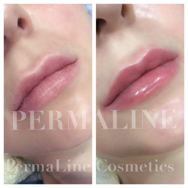 A woman's lips before and after a lip filler treatment.