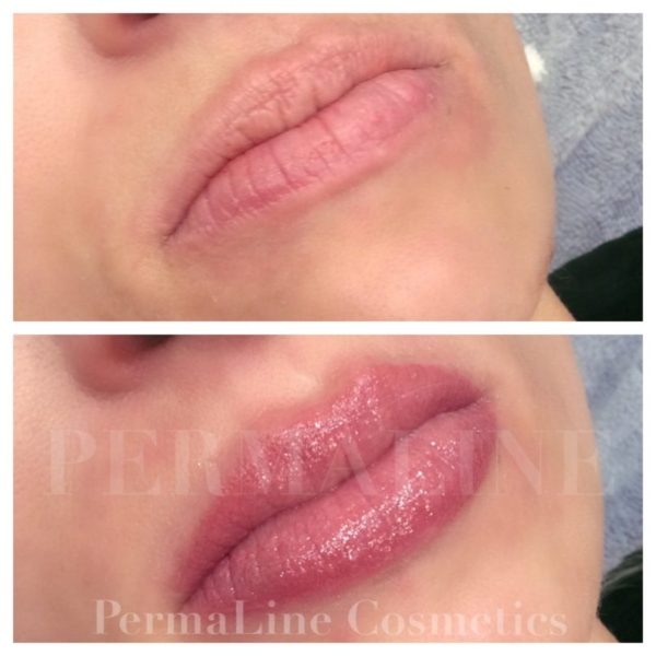 A woman's lips before and after lip filler.