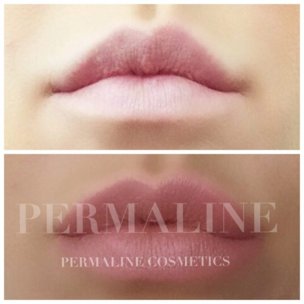 Two pictures of a woman's lips before and after lip filler.