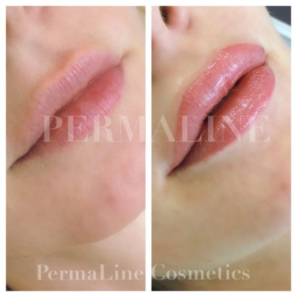 A woman's lips before and after a lip filler treatment.