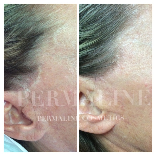 Before and after photo of a woman with wrinkles.