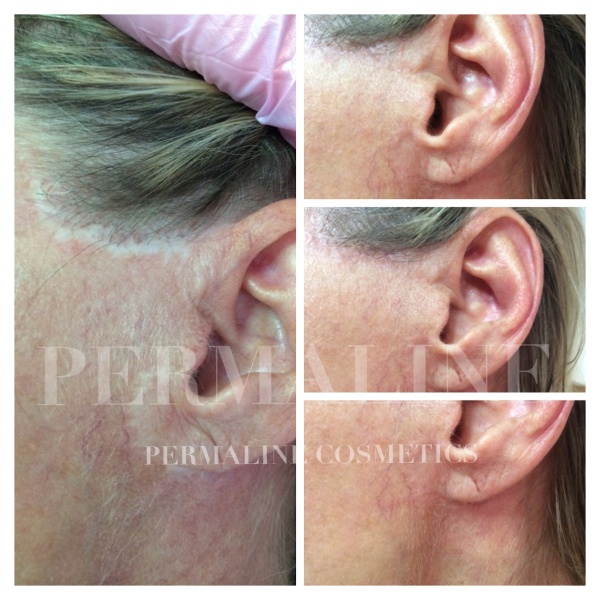 A woman's ear is shown before and after a procedure.