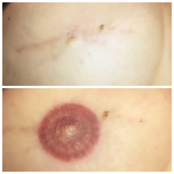 A woman's breast before and after surgery.