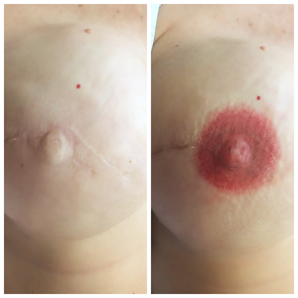Two pictures of a woman with a scar on her breast.