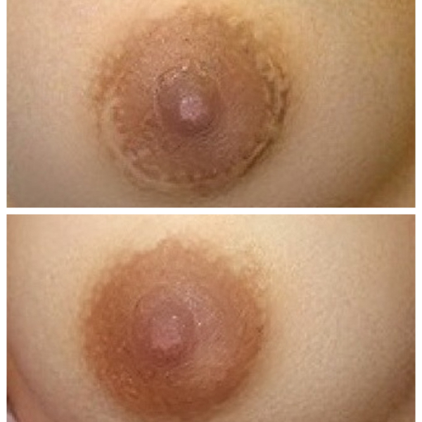 A woman's breast before and after a breast lift.