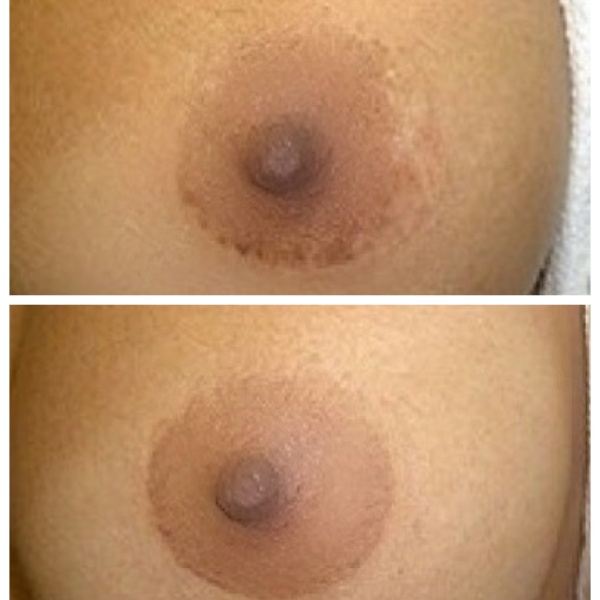 A woman's breast before and after a breast lift.