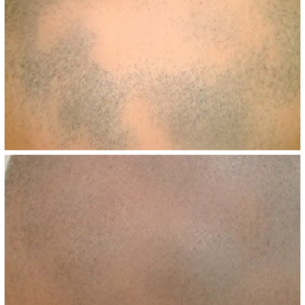 A man's skin before and after laser hair removal.