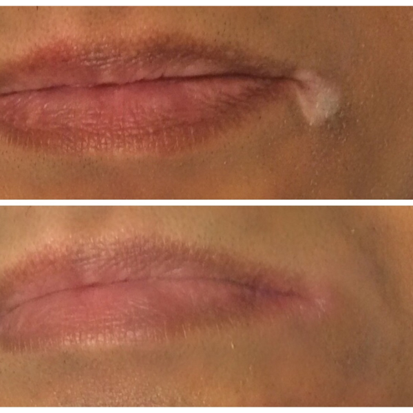 Before and after photos of a woman's lips.